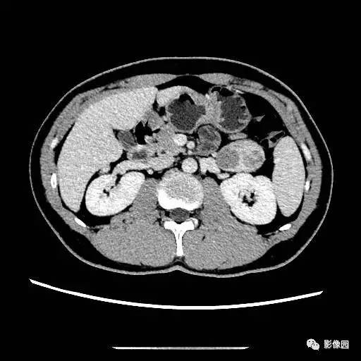 【病例】胰腺内异位脾伴异位脾表皮样囊肿一例CT 【病例】胰腺内异位脾伴异位脾表皮样囊肿一例CT