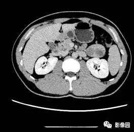 【病例】胰腺内异位脾伴异位脾表皮样囊肿一例CT 【病例】胰腺内异位脾伴异位脾表皮样囊肿一例CT