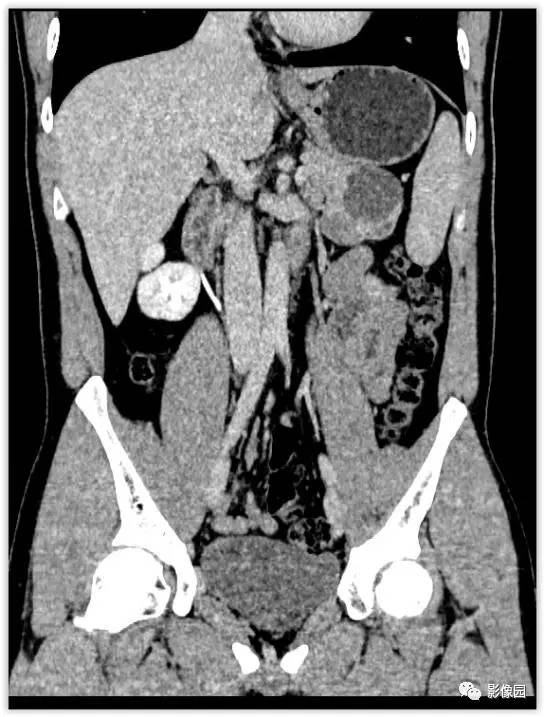 【病例】胰腺内异位脾伴异位脾表皮样囊肿一例CT 【病例】胰腺内异位脾伴异位脾表皮样囊肿一例CT