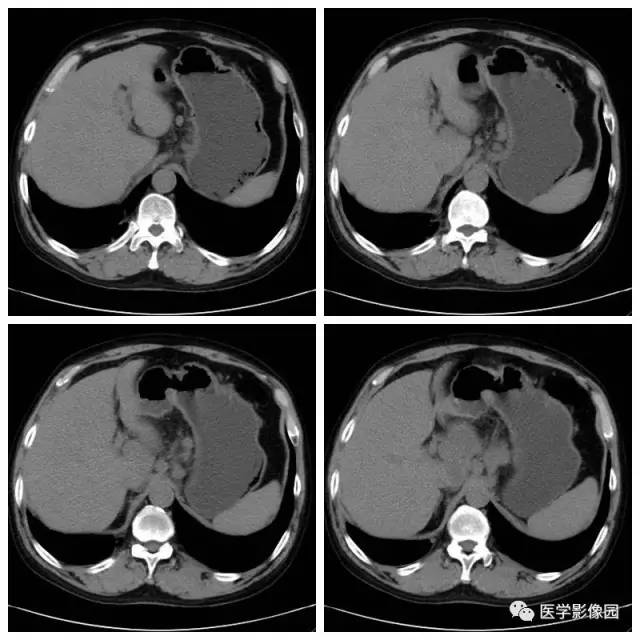 【病例】腹部淋巴瘤1例CT影像表现