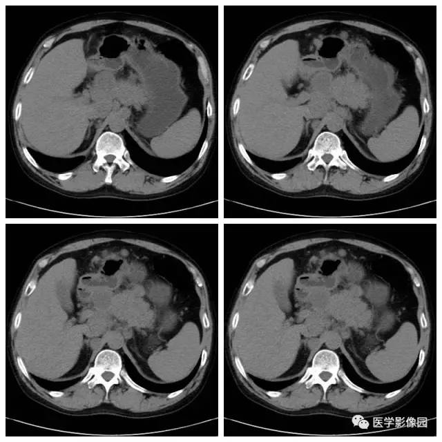 【病例】腹部淋巴瘤1例CT影像表现
