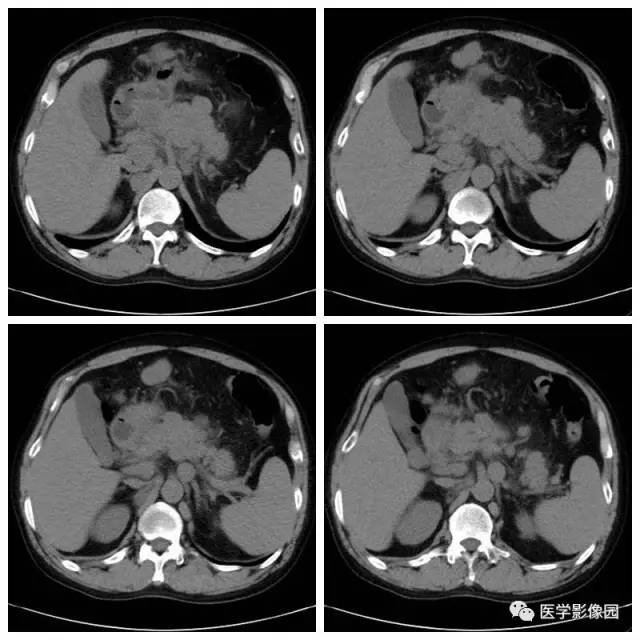【病例】腹部淋巴瘤1例CT影像表现