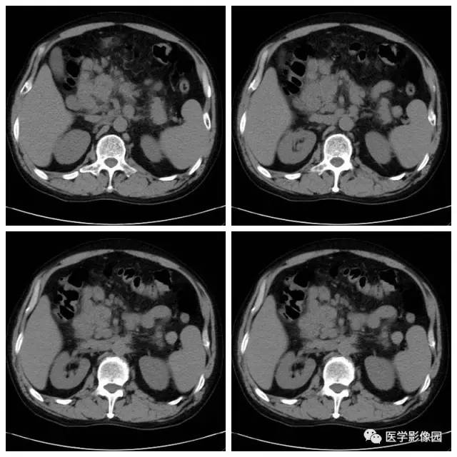 【病例】腹部淋巴瘤1例CT影像表现