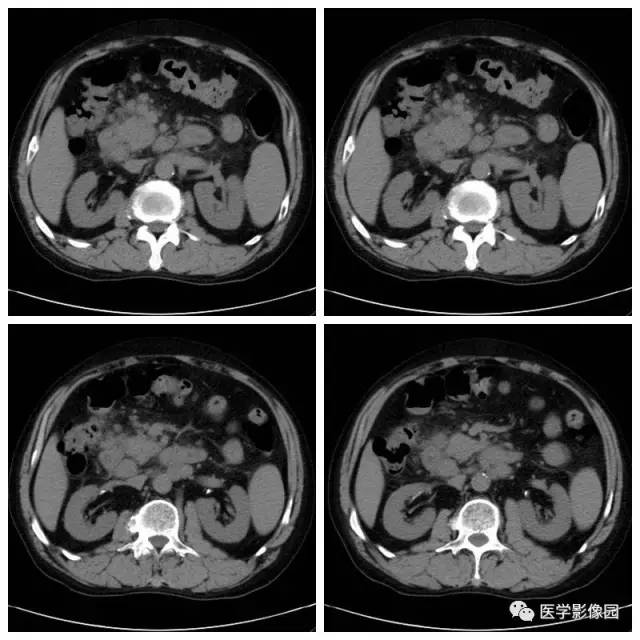 【病例】腹部淋巴瘤1例CT影像表现
