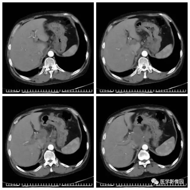 【病例】腹部淋巴瘤1例CT影像表现