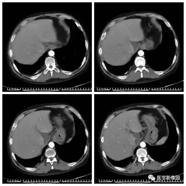 【病例】腹部淋巴瘤1例CT影像表现
