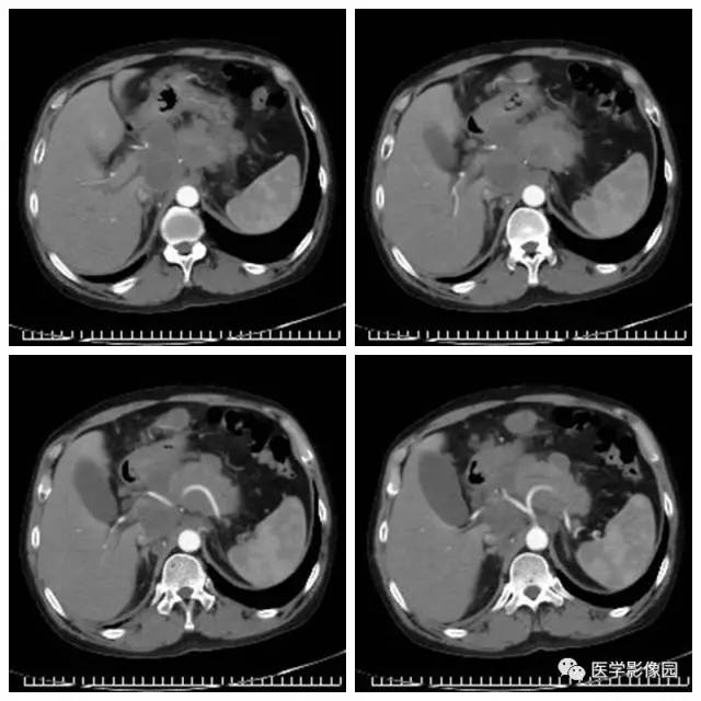 【病例】腹部淋巴瘤1例CT影像表现