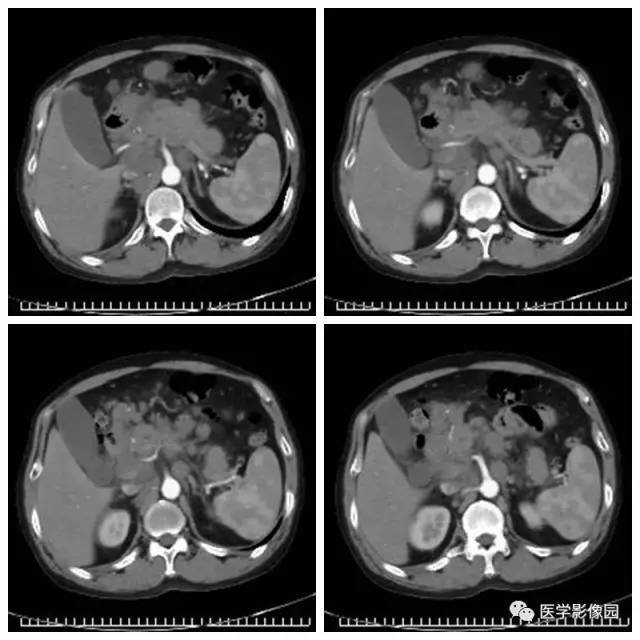 【病例】腹部淋巴瘤1例CT影像表现