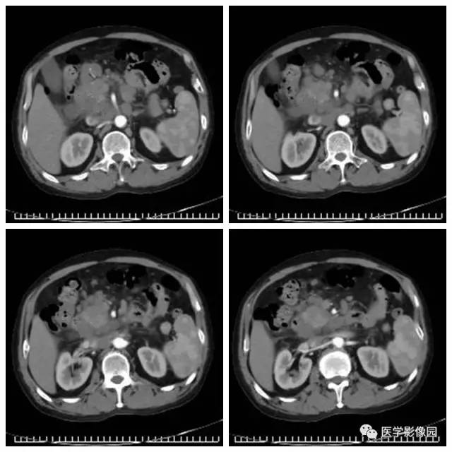 【病例】腹部淋巴瘤1例CT影像表现