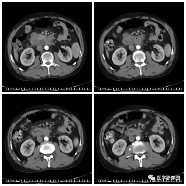 【病例】腹部淋巴瘤1例CT影像表现