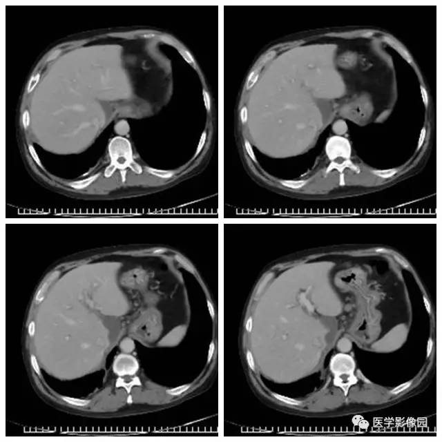 【病例】腹部淋巴瘤1例CT影像表现