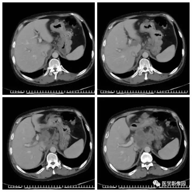 【病例】腹部淋巴瘤1例CT影像表现