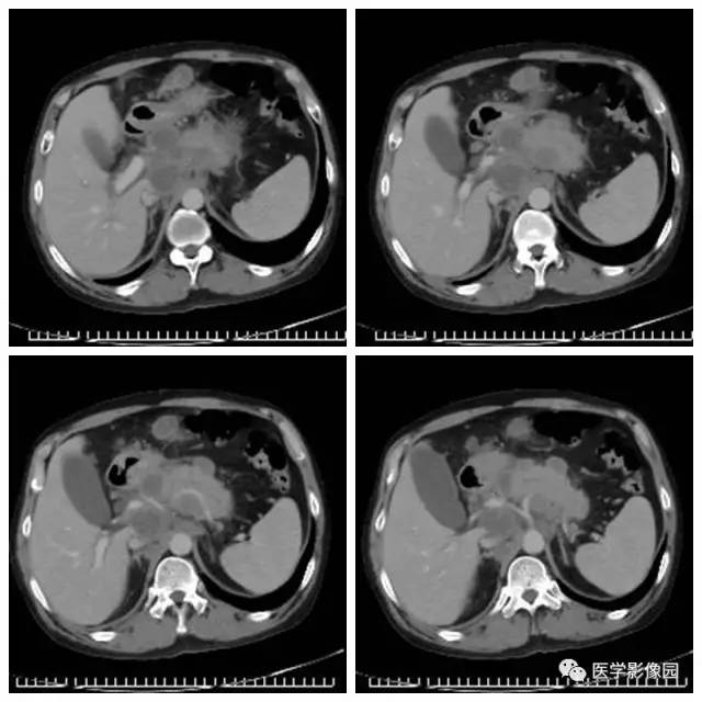 【病例】腹部淋巴瘤1例CT影像表现