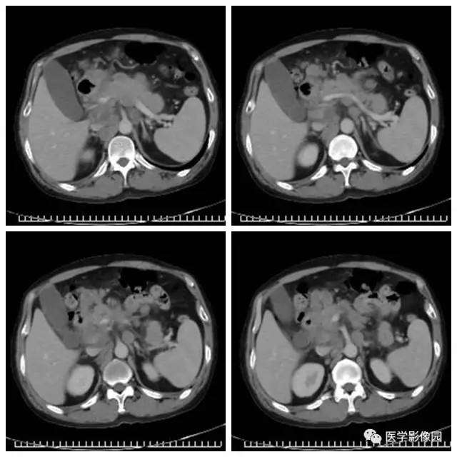 【病例】腹部淋巴瘤1例CT影像表现