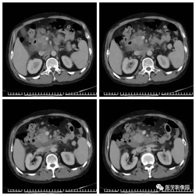 【病例】腹部淋巴瘤1例CT影像表现