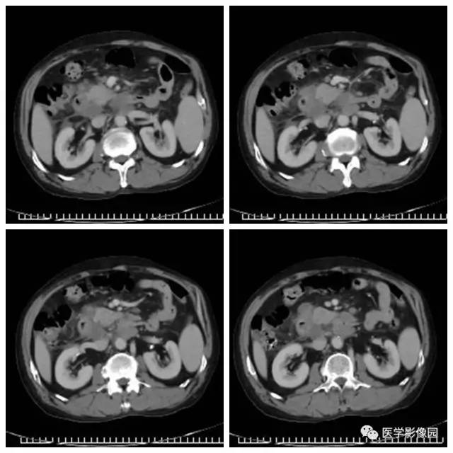 【病例】腹部淋巴瘤1例CT影像表现