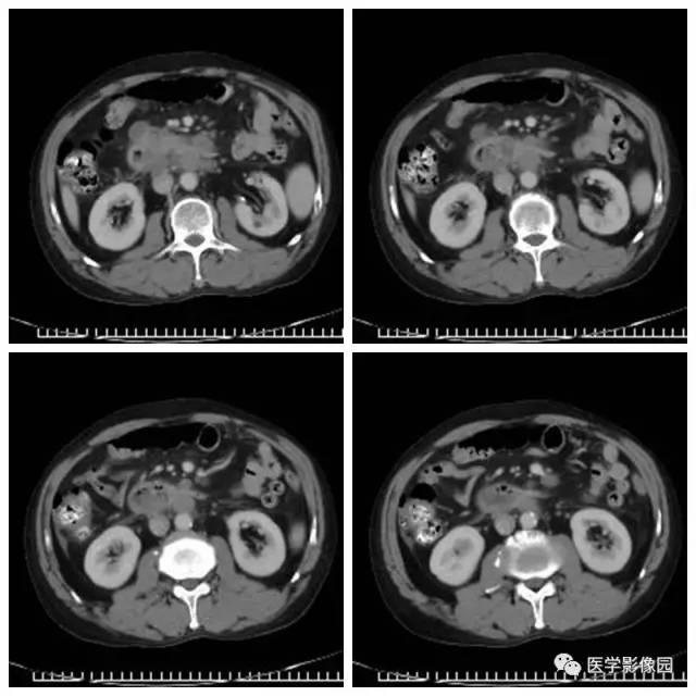 【病例】腹部淋巴瘤1例CT影像表现