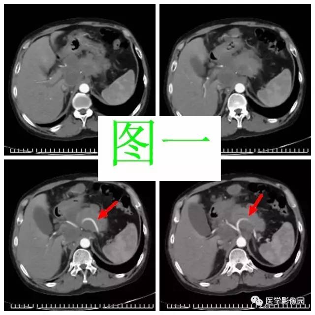 【病例】腹部淋巴瘤1例CT影像表现