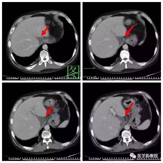 【病例】腹部淋巴瘤1例CT影像表现