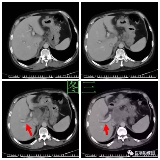 【病例】腹部淋巴瘤1例CT影像表现