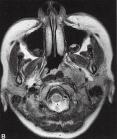 【病例】咽旁异位脑膜瘤1例MR影像表现 【病例】咽旁异位脑膜瘤1例MR影像表现