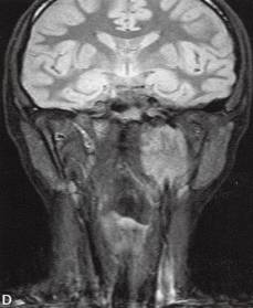 【病例】咽旁异位脑膜瘤1例MR影像表现 【病例】咽旁异位脑膜瘤1例MR影像表现