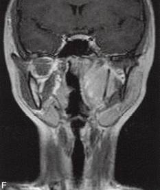 【病例】咽旁异位脑膜瘤1例MR影像表现 【病例】咽旁异位脑膜瘤1例MR影像表现