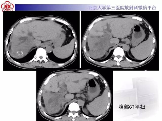 【病例】肝内胆管导管内乳头状管状肿瘤1例CT及MR