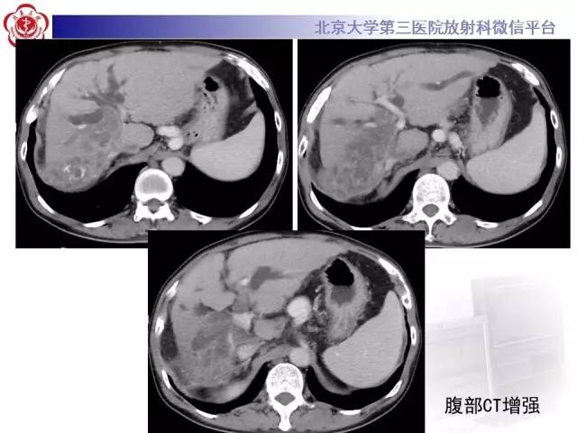 【病例】肝内胆管导管内乳头状管状肿瘤1例CT及MR