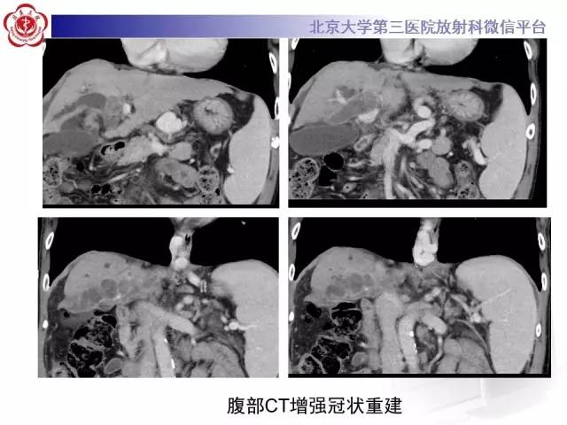 【病例】肝内胆管导管内乳头状管状肿瘤1例CT及MR