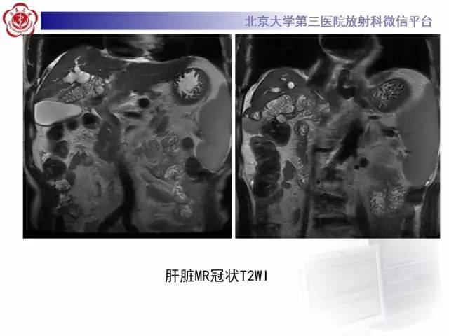 【病例】肝内胆管导管内乳头状管状肿瘤1例CT及MR