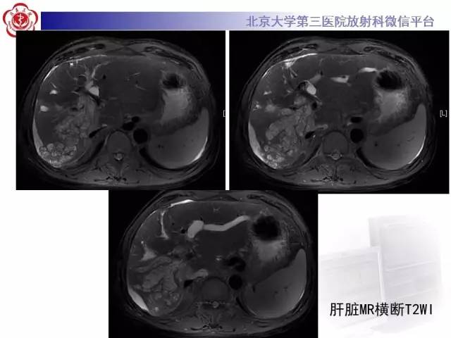 【病例】肝内胆管导管内乳头状管状肿瘤1例CT及MR
