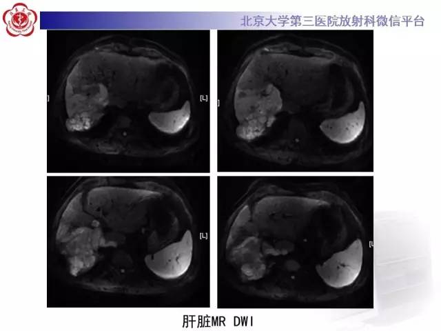 【病例】肝内胆管导管内乳头状管状肿瘤1例CT及MR