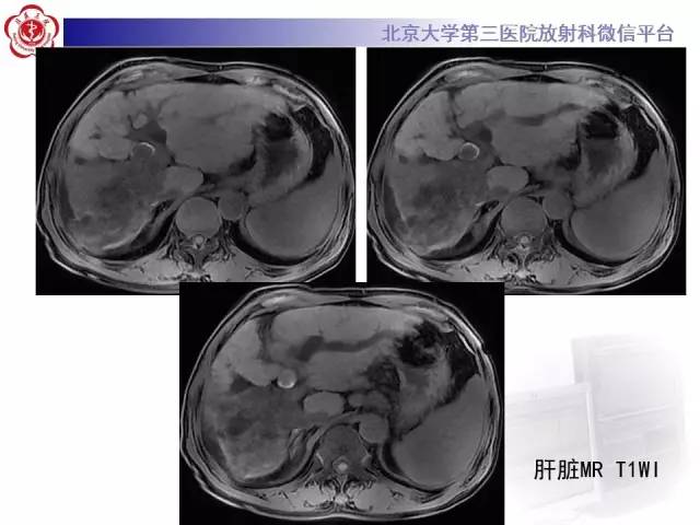 【病例】肝内胆管导管内乳头状管状肿瘤1例CT及MR