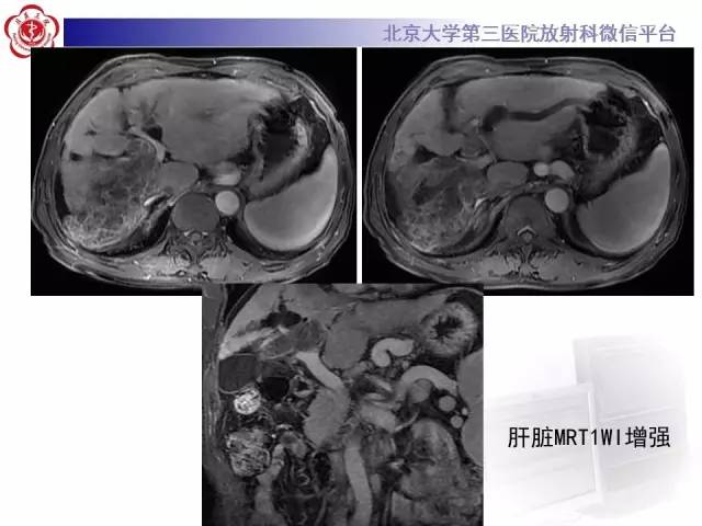 【病例】肝内胆管导管内乳头状管状肿瘤1例CT及MR