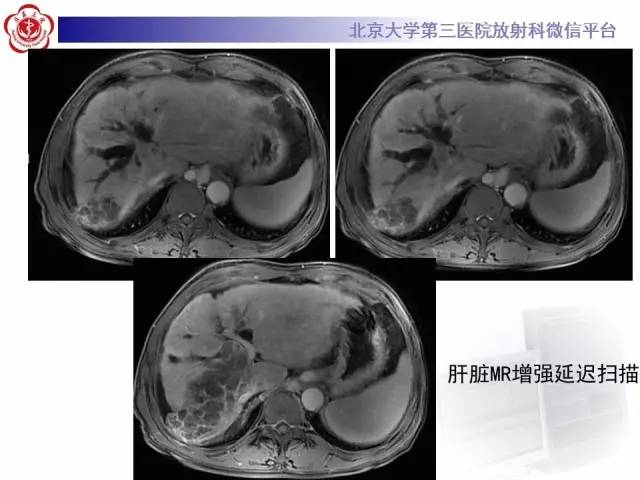 【病例】肝内胆管导管内乳头状管状肿瘤1例CT及MR