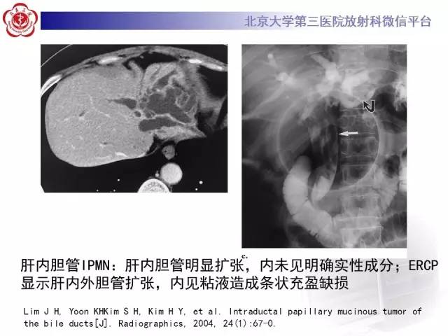 【病例】肝内胆管导管内乳头状管状肿瘤1例CT及MR