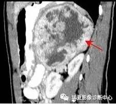 腹膜后常见良性神经源性肿瘤的鉴别诊断