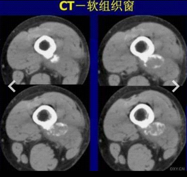 骨关节影像学征象—— 骨关节影像学征象——