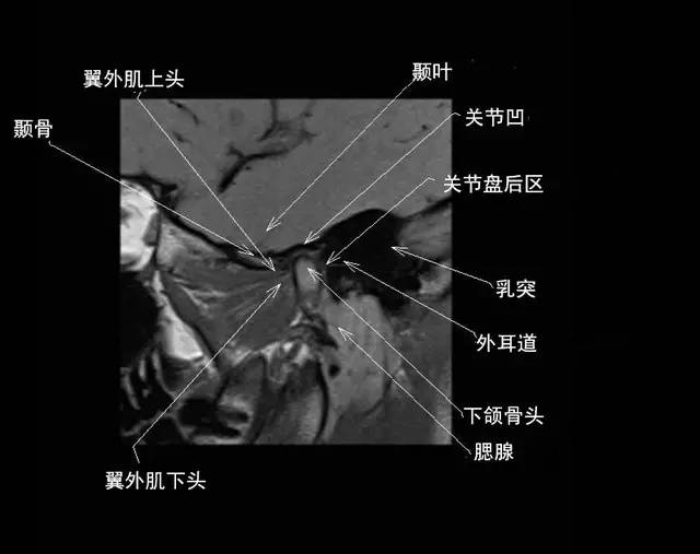 颞下颌关节解剖