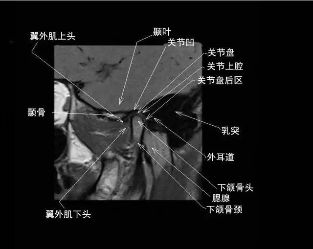 颞下颌关节解剖