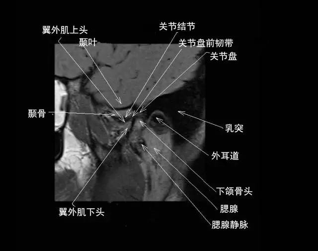 颞下颌关节解剖
