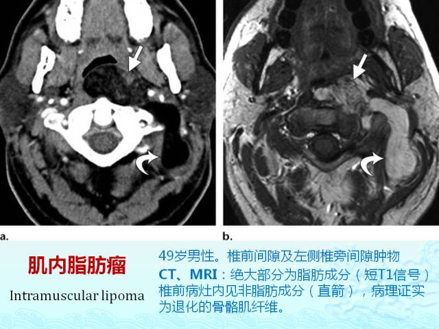 【PPT】头颈部软组织肿瘤的影像表现