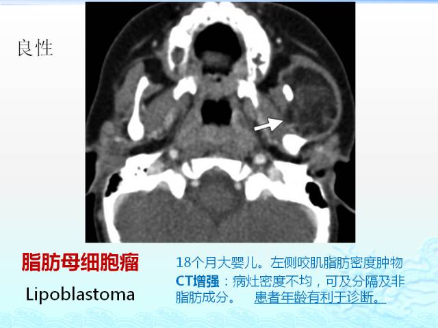 【PPT】头颈部软组织肿瘤的影像表现