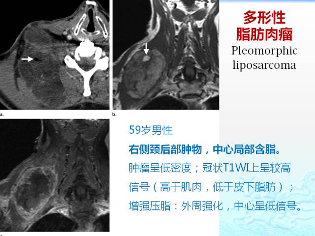 【PPT】头颈部软组织肿瘤的影像表现