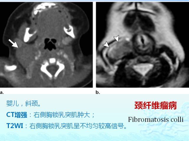 【PPT】头颈部软组织肿瘤的影像表现