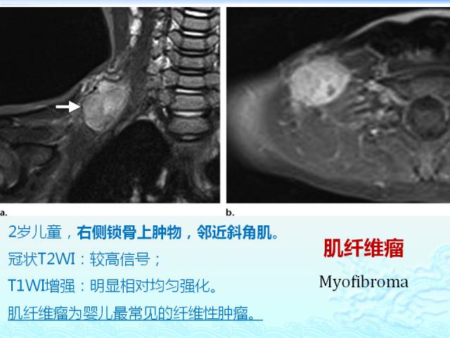【PPT】头颈部软组织肿瘤的影像表现