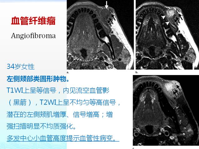 【PPT】头颈部软组织肿瘤的影像表现