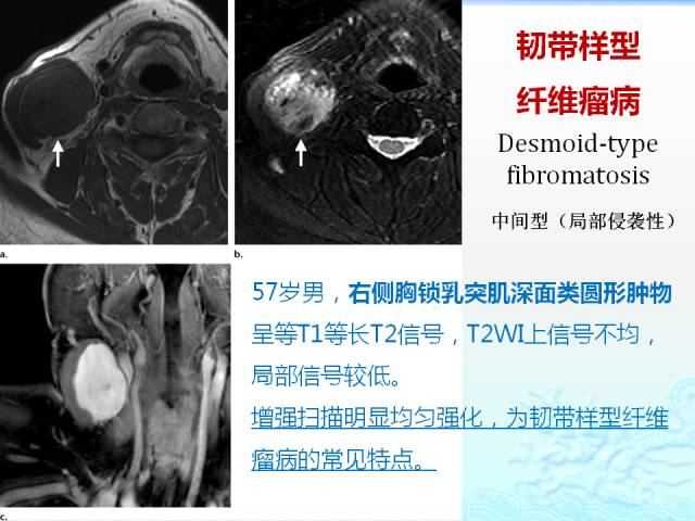 【PPT】头颈部软组织肿瘤的影像表现