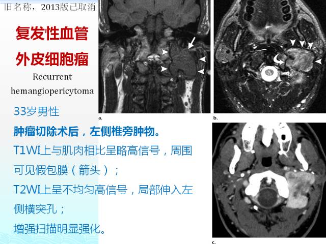 【PPT】头颈部软组织肿瘤的影像表现